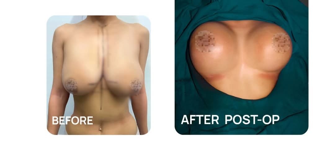 Breast Augmentation before and after