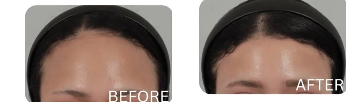 Forehead Reduction before and after