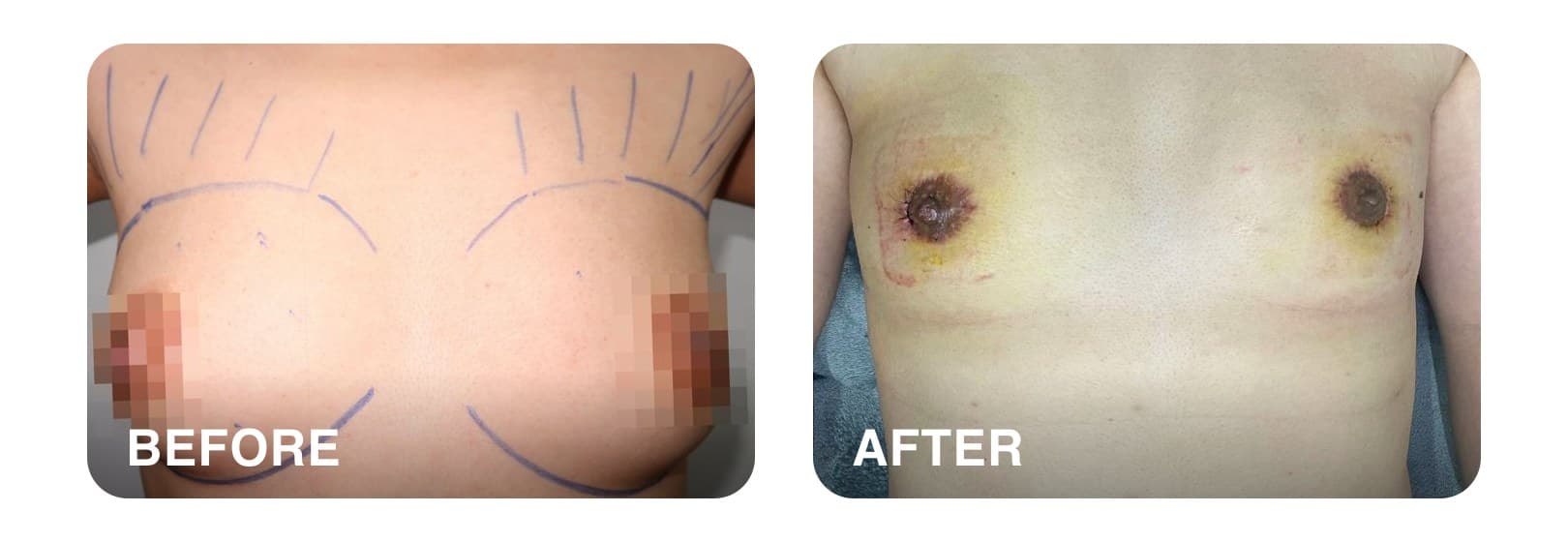 Before and after periareolar top surgery