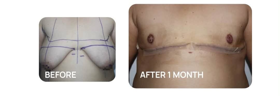 Top Surgery before and after